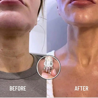 Professional Micro-Infusion Skin Rejuvenation System