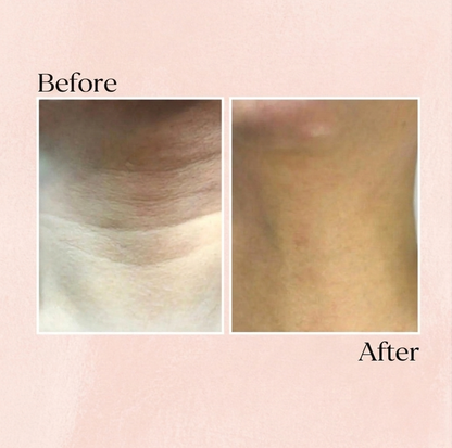 Professional Micro-Infusion Skin Rejuvenation System